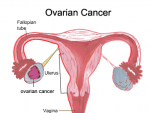 Depistarea timpurie a cancerului ovarian
